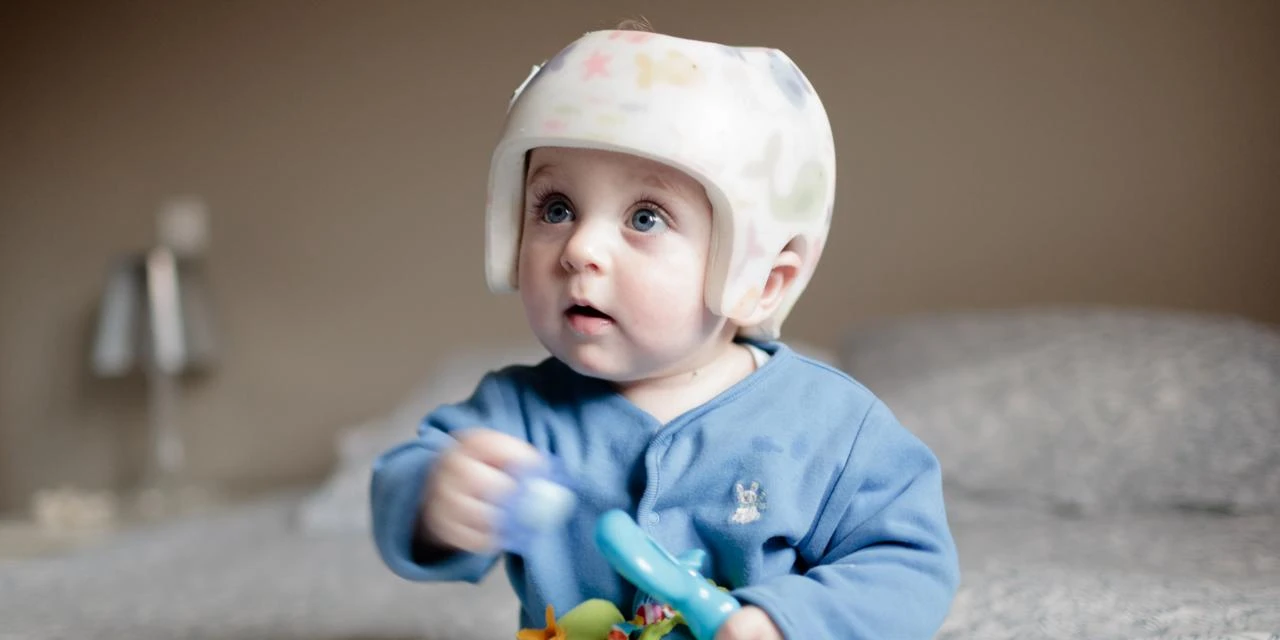 Capacete para assimetria craniana: quando realmente ...