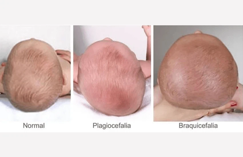 Dicas para Prevenir a Assimetria Craniana em Bebês