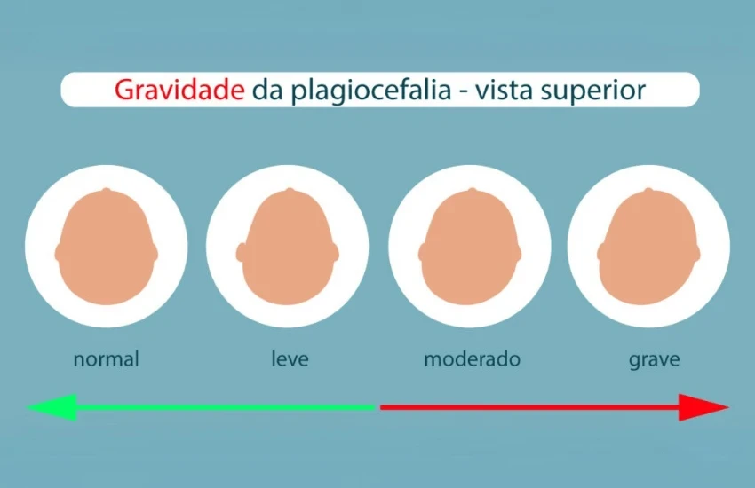 Mitos e Verdades Sobre a Assimetria Craniana em Bebês